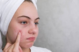 How to Get Rid of Perioral Dermatitis Overnight