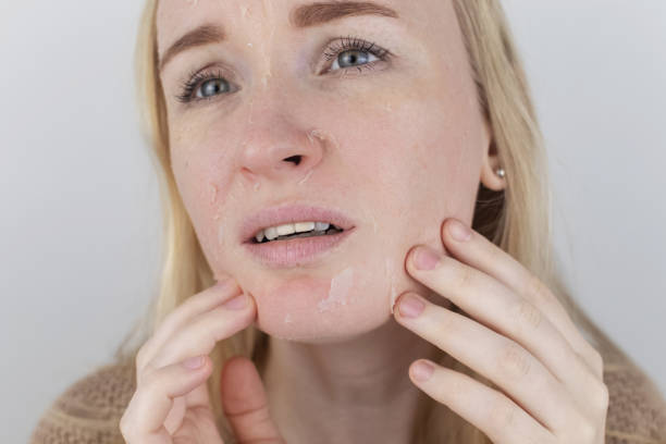 Natural remedies and medications for effective perioral dermatitis treatment